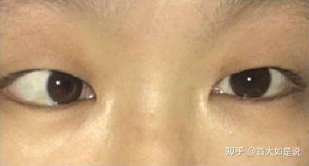 首大熊瑛儿童斜视常见的表现有哪些