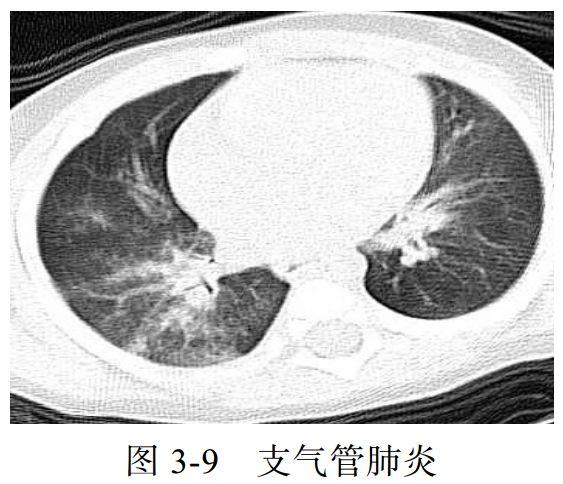 新冠肺炎ct早期征象与鉴别诊断 知乎 8957