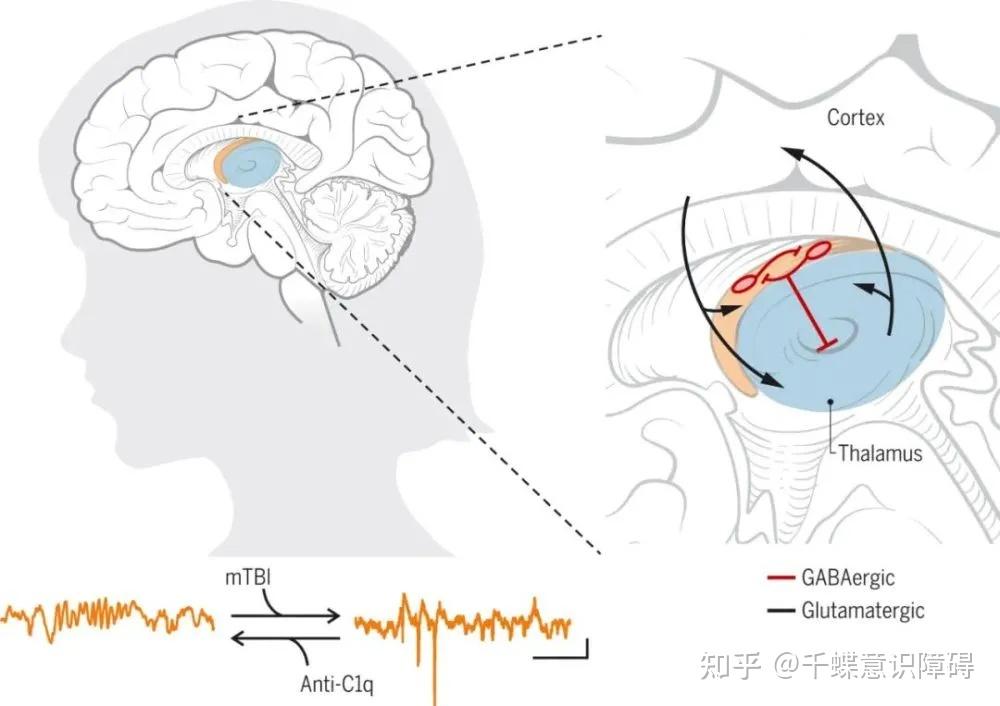 颅脑创伤后的继发性脑损伤是怎么发生的?Science:补体介导炎症及神经损伤 - 知乎