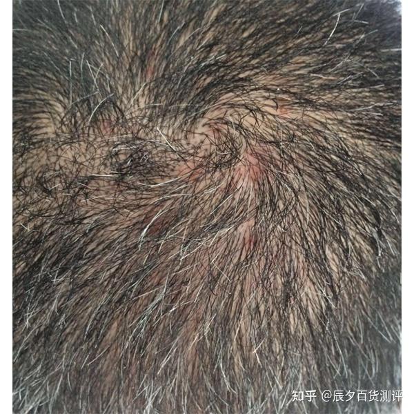 止痒养发养头皮的洗发水有哪些?「头屑问题消失术」 - 知乎
