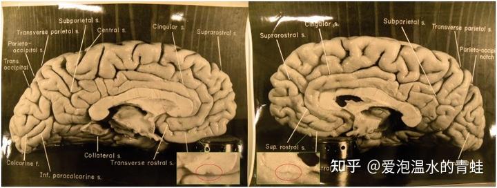为什么人与人之间的智商不同?大脑结构有差异吗? 6 v2 3c8cf32cd864ae36f0dc77df94dcd8eb 720w