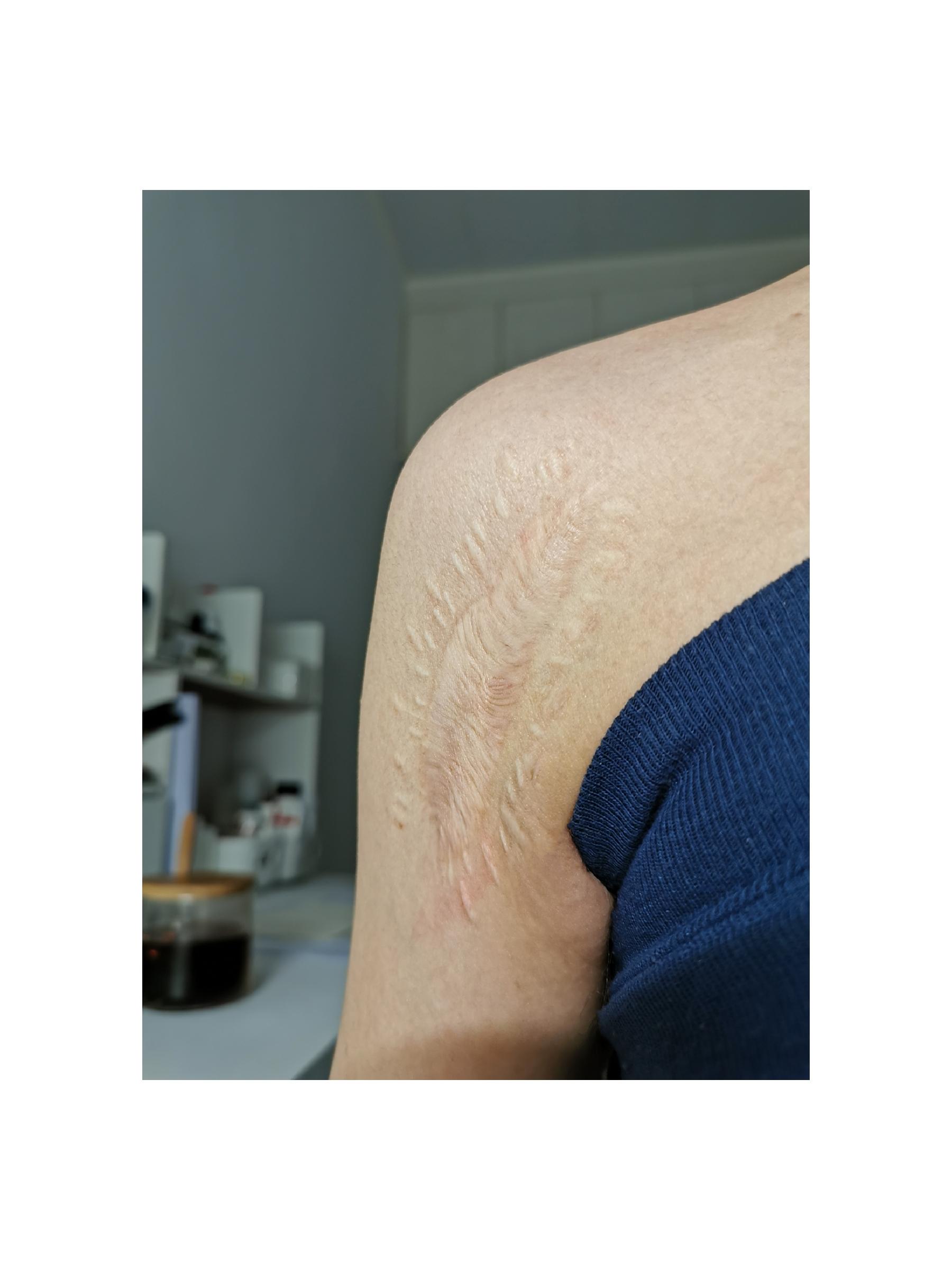 的疤拆了钢板也有一年半了疤越来越大且凸起有时痒不知是否疤痕增生