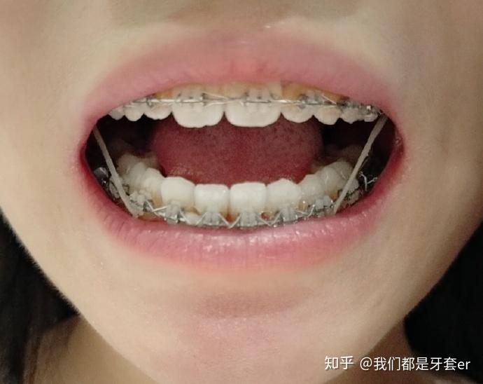 矫正 | 双颌前突,从小被叫大龅牙,不敢笑,历时8年说服家人才戴上牙套