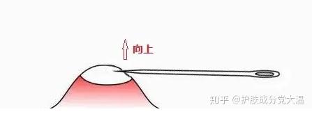 满脸闭口，要不要针清呢？（关于针清，看这篇文章就够了！） - 知乎
