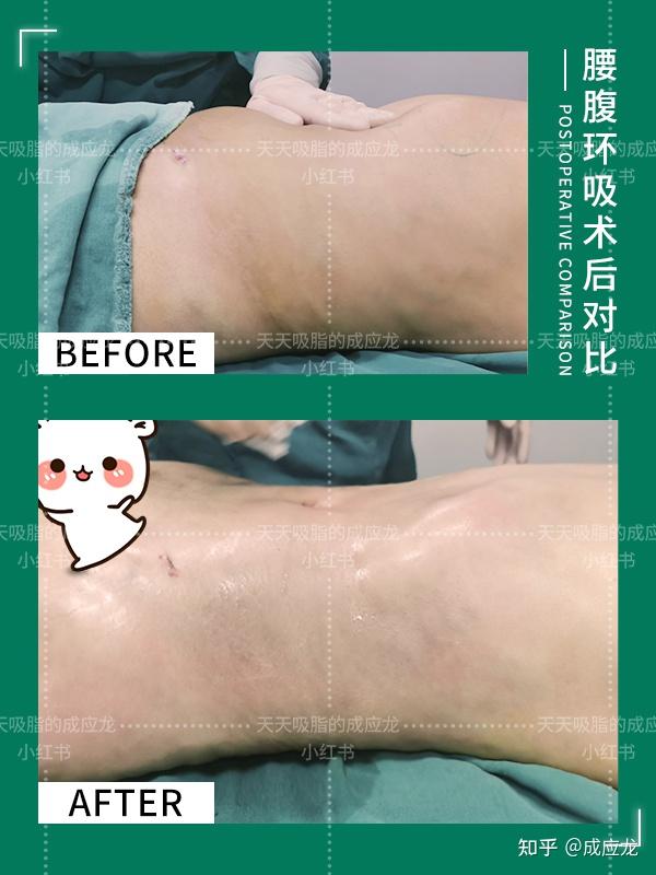 大多数求美者在做吸脂手术之前都会问一个共同的问题"吸脂后皮肤会