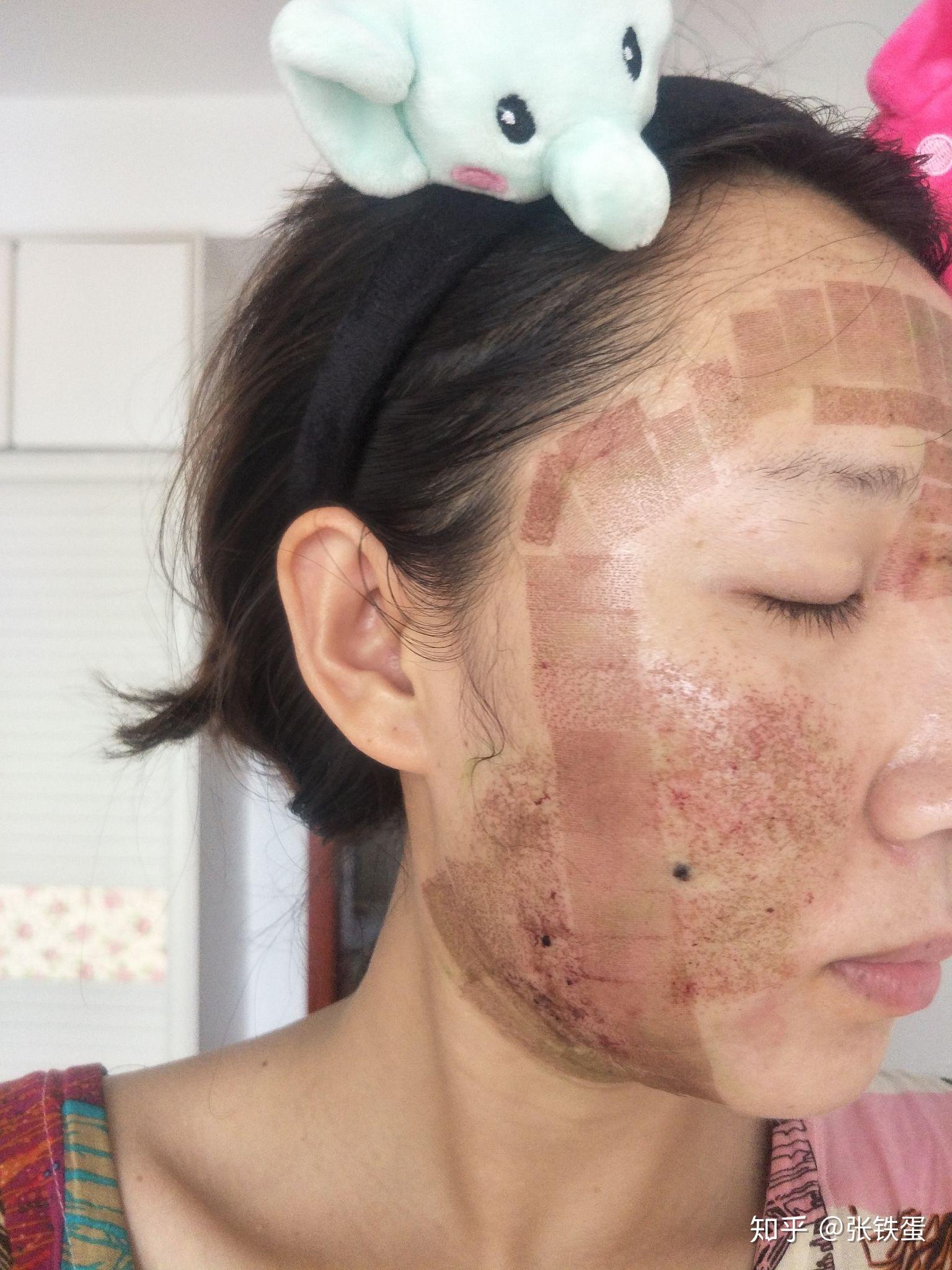 祛痘坑第六次二氧化碳激光