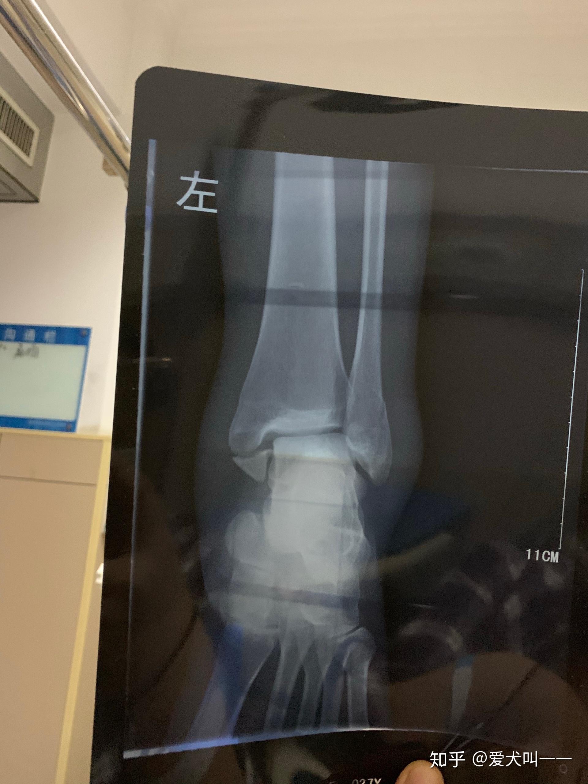 双侧脚踝骨折的手术记录