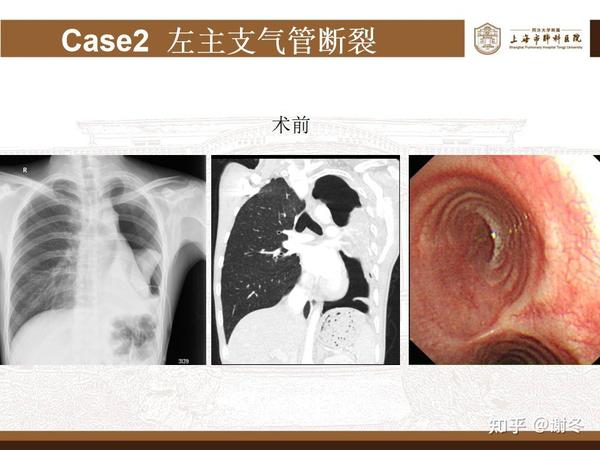 气管外伤、气管断裂——气管支气管裂伤是什么? 如何治疗? - 知乎