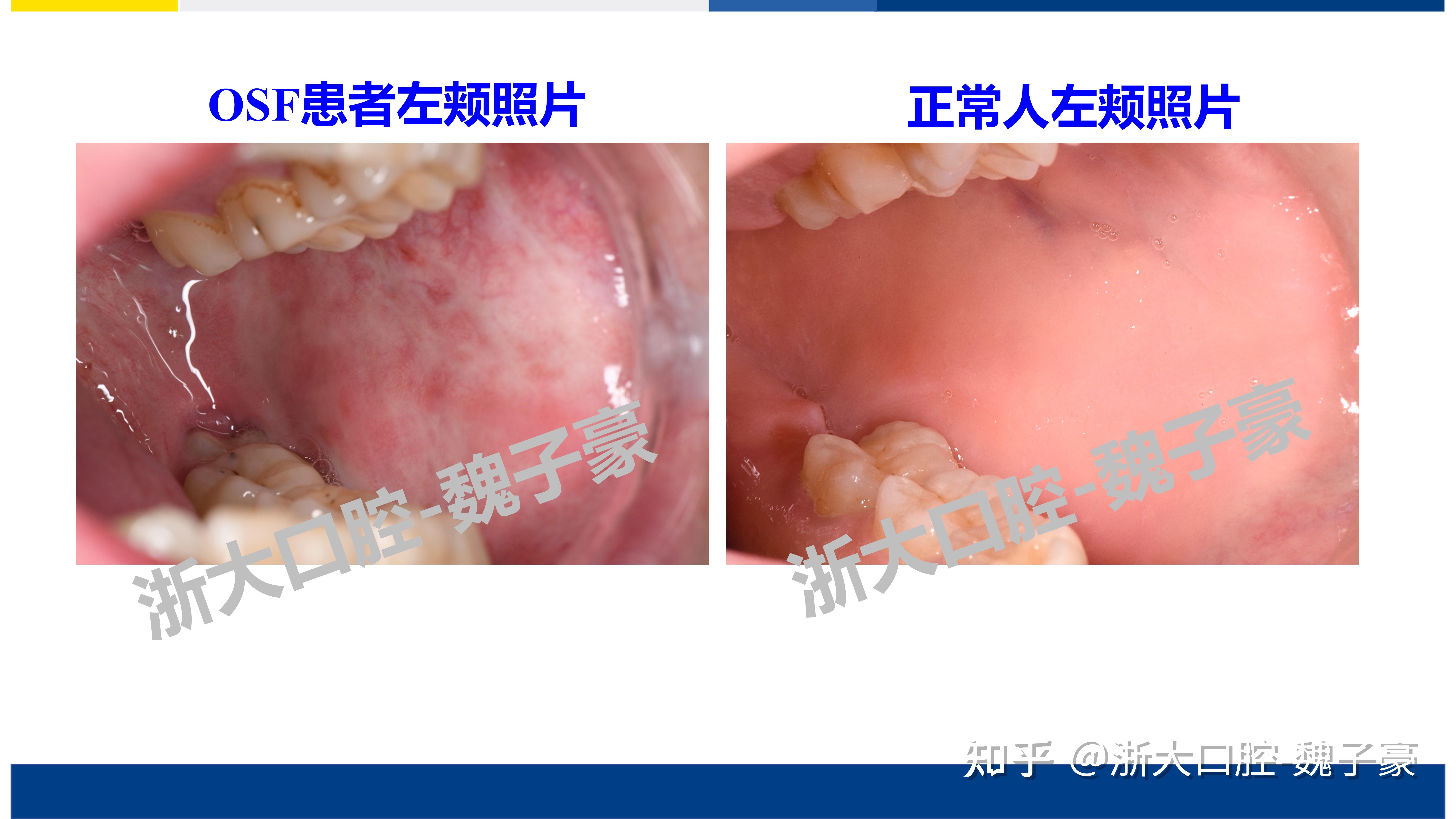 口腔纤维化自愈图片