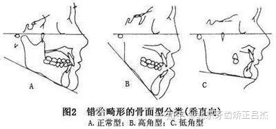 正畸中骨性面型的分类 知乎