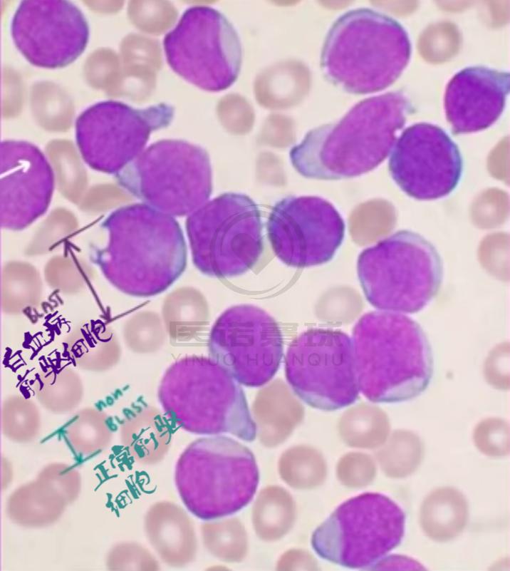 白血病系列之一（白血病机理及分类） 知乎