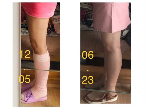 骨盆前倾,这不是病,其实类似非病理性驼背,是体态问题. 2.膝超伸.