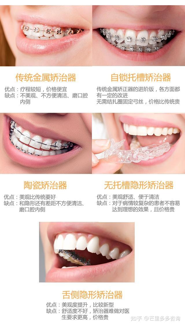 上海整牙上海牙齿矫正的正畸医院医生求推荐牙套怎么选择才好牙套戴久