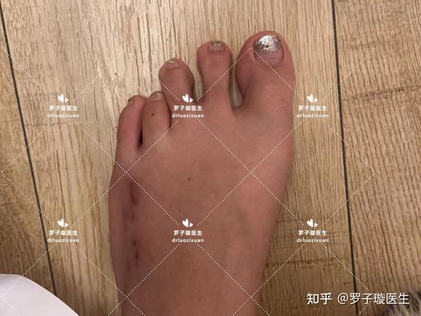 各种类型短趾症(脚趾短小症)术前术后对比。(持续更新中,20240513) - 知乎