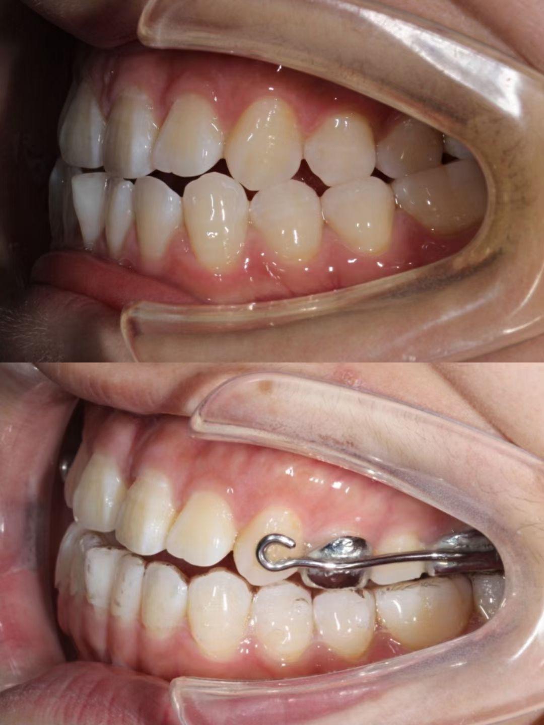 moon教授关于mse的精彩分享,他最早提出上颌骨性扩弓理念并做了大量的