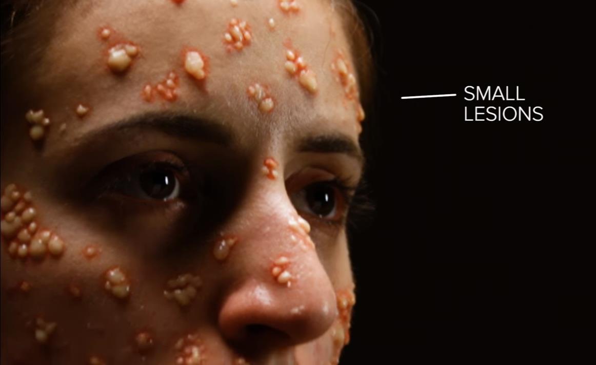 人类历史上的6种致命疾病图片有点重口