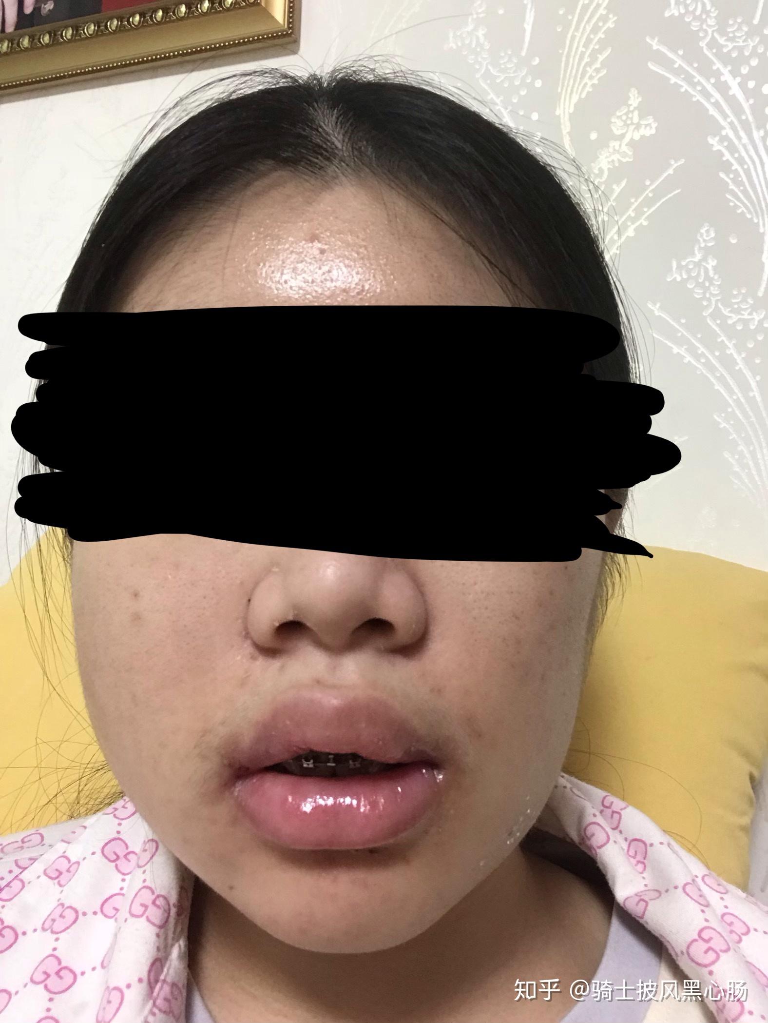 做了正颌手术的我已经一年半了  来分享经历  希望能给想做的提供一些