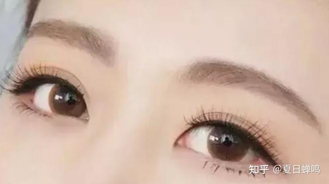 全切双眼皮,定点双眼皮,埋线双眼皮,适应人群以及优缺点,整理的很全 - 知乎