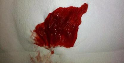 "今天早上上厕所时肛门特别疼痛,不知道怎么回事,一直疼到现在,有种