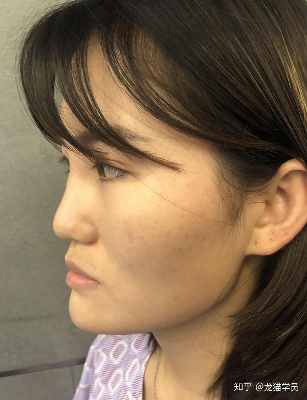 鼻基底填充的效果怎么样?怎么判断鼻基底是否凹陷? - 知乎