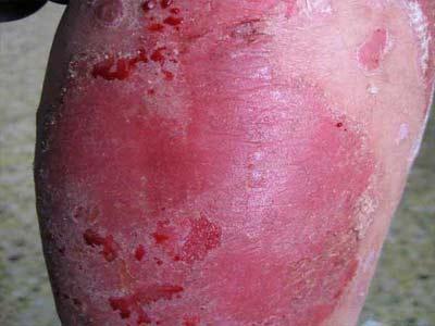 银屑病的症状 zhuanlan.zhihu.com