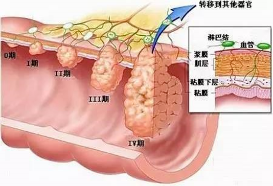 ③组织学分级:针对结直肠腺癌(普通型),组织学分级标准见表5