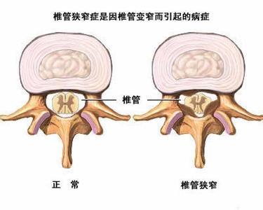 真假李逵 腰椎间盘突出症中的李鬼你遇见几个 知乎