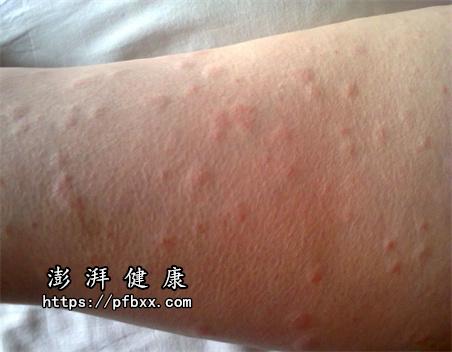 小孩一热胳膊就起红色块状凸起物身上长疹子,不热就消退,是什么病?咋治可以治好了? - 知乎