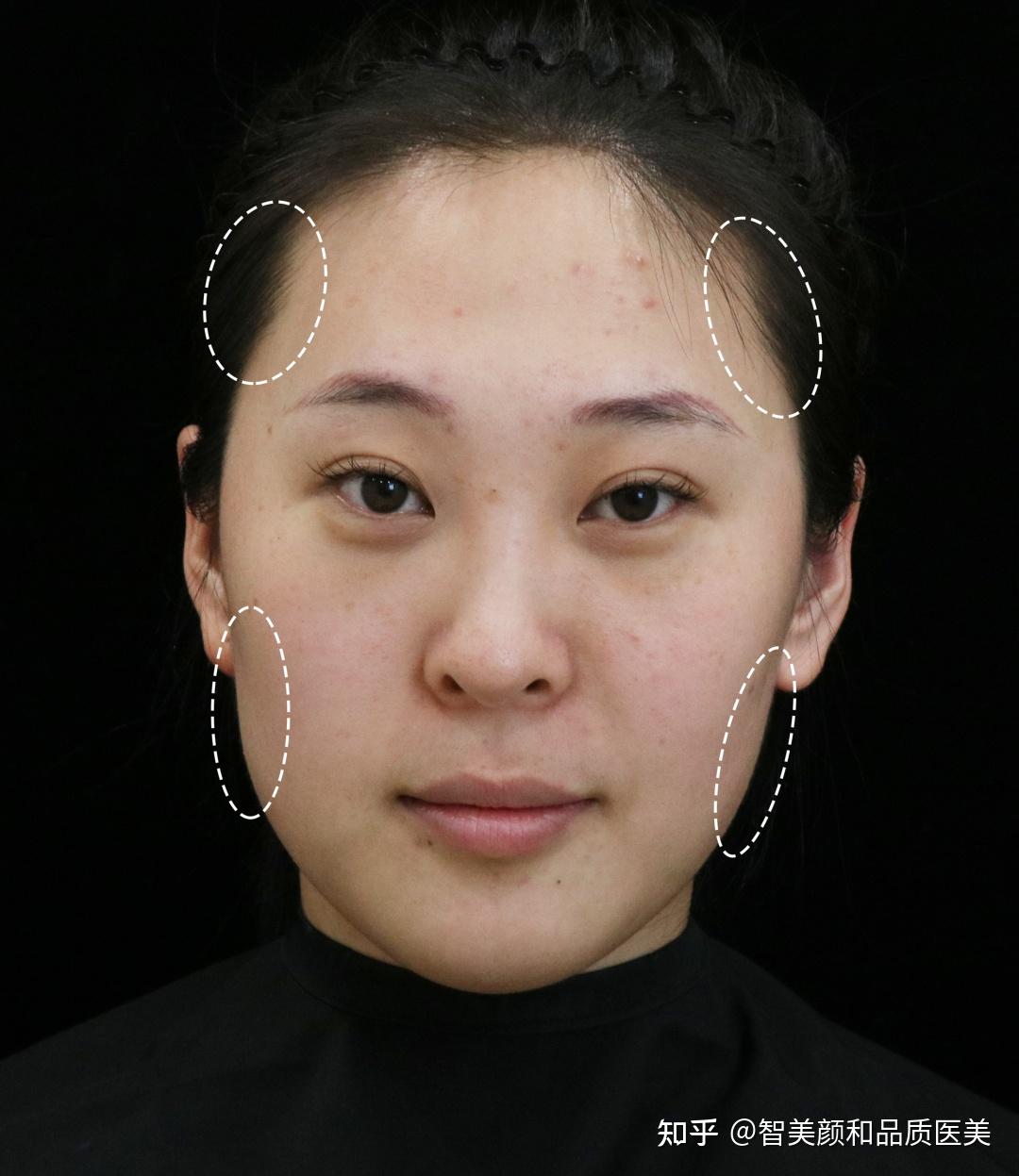 医美新风向为什么现在大家更喜欢轮廓微调