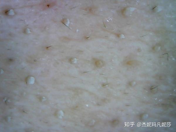 毛孔粗大,毛孔脏东西多怎么办?