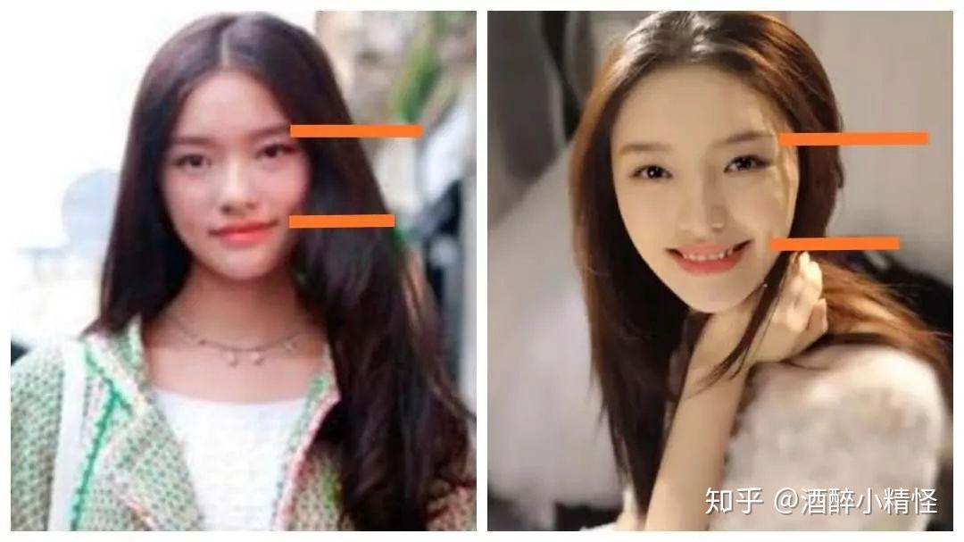 林允的烤瓷牙为什么不好看整牙真的会变牙套脸吗