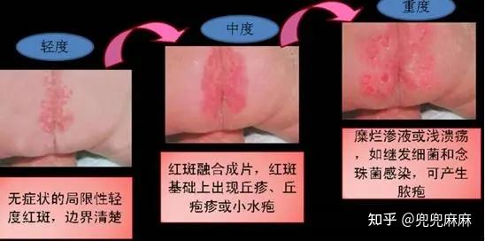 二,关于宝宝屁屁会出现的症状