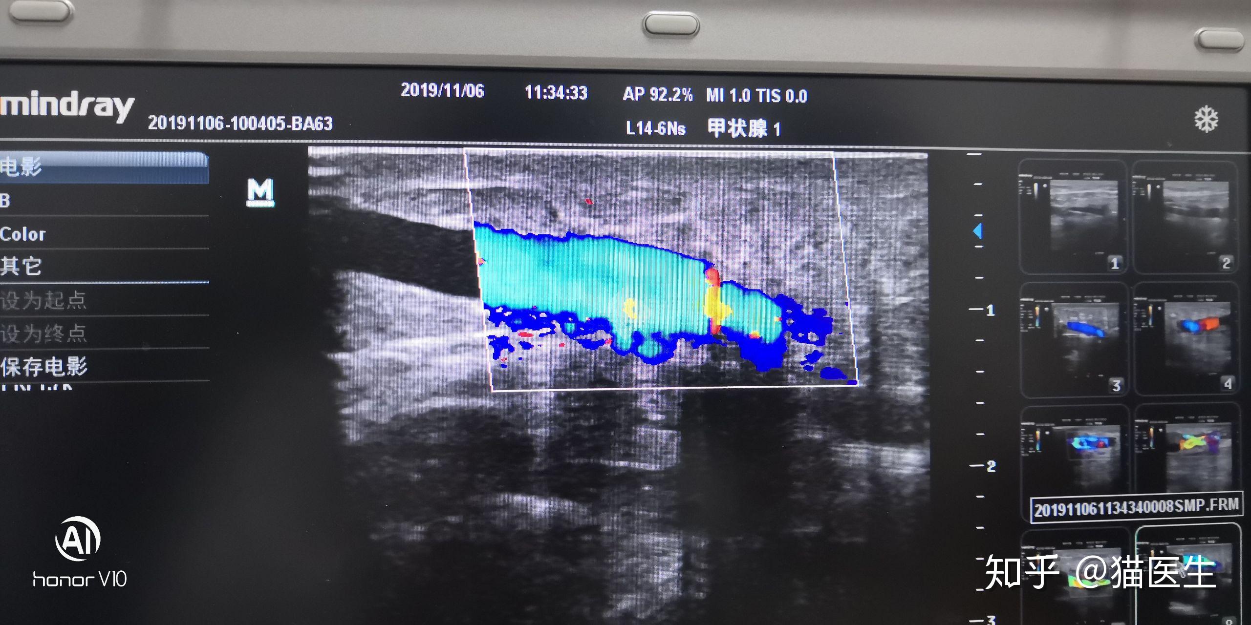 优化设计方案治疗头静脉弓狭窄闭塞