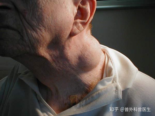 怎么样判断结节的良恶性,我来教大家几招