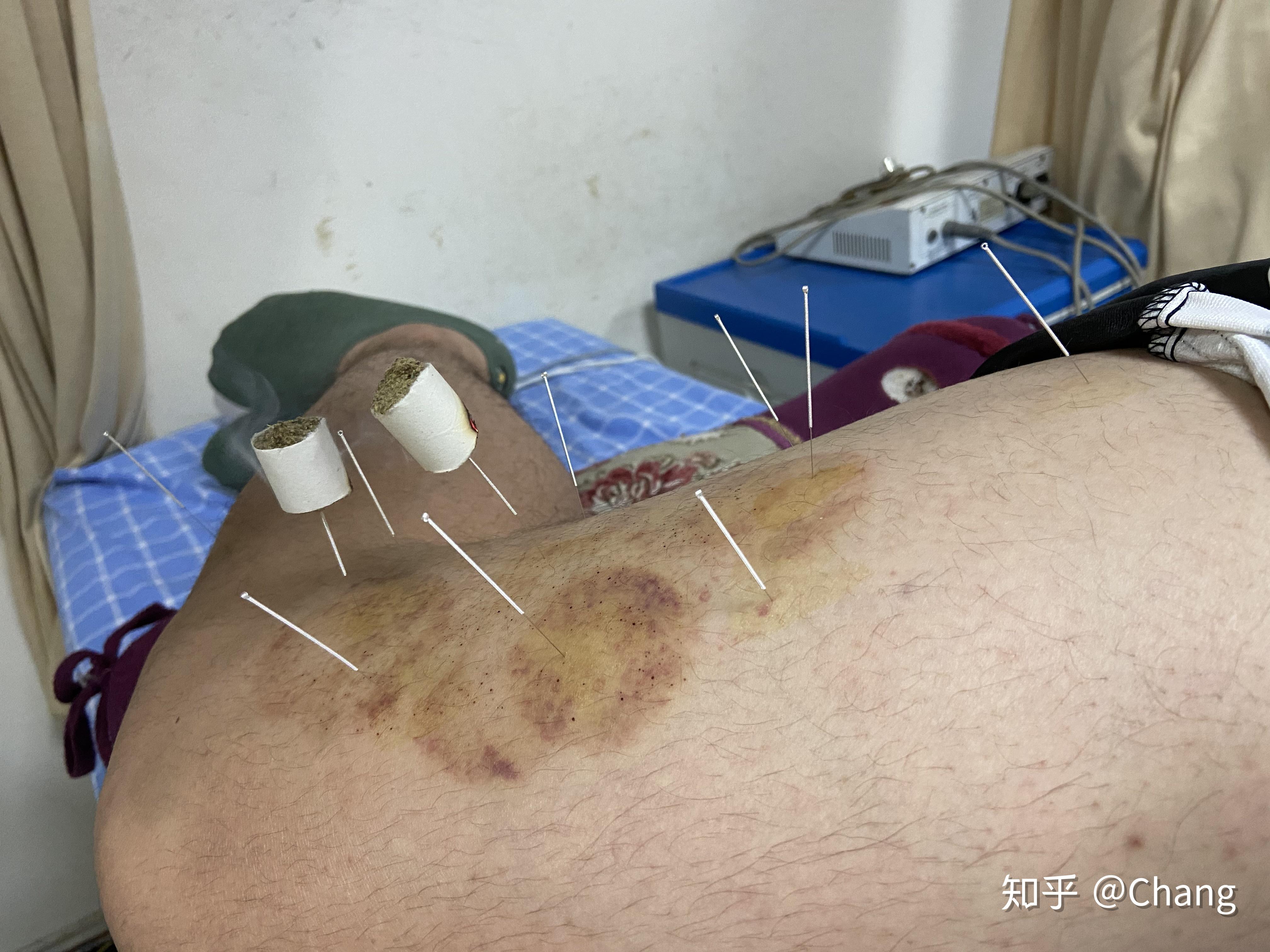 做个股外侧皮神经炎治疗日记吧 - 知乎