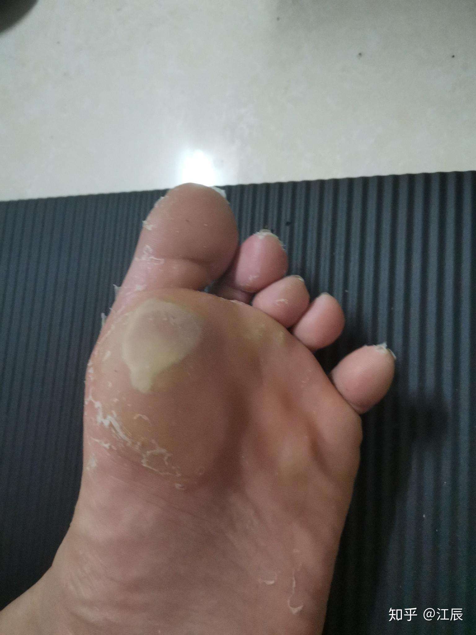 打篮球脚底起泡怎么办