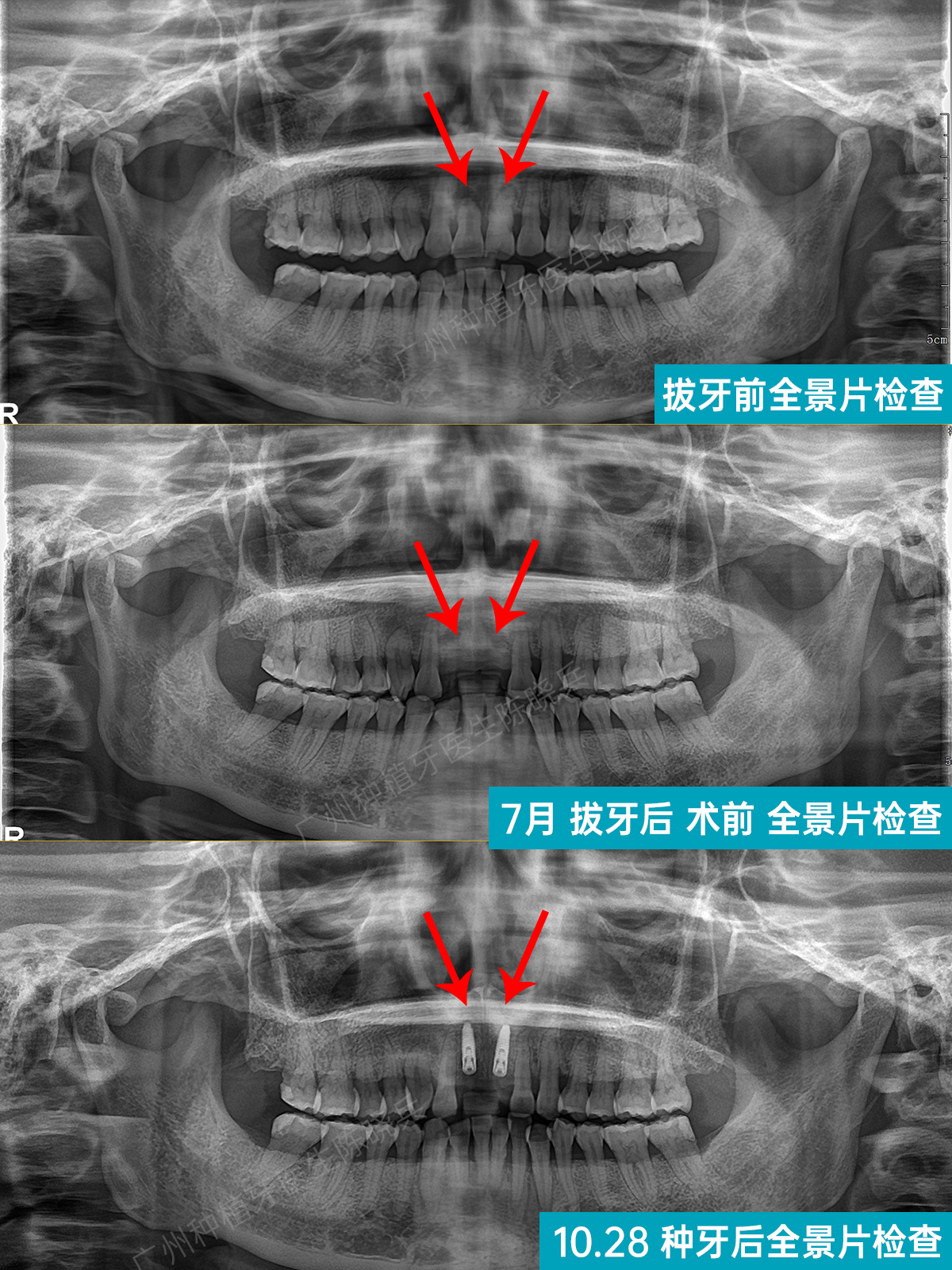 门牙植骨种牙术后一个月复查广州种植牙广州种牙