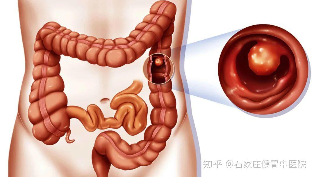 結腸癌早期沒有什麼臨床症狀或臨床症狀不明顯,而當隨著病情的