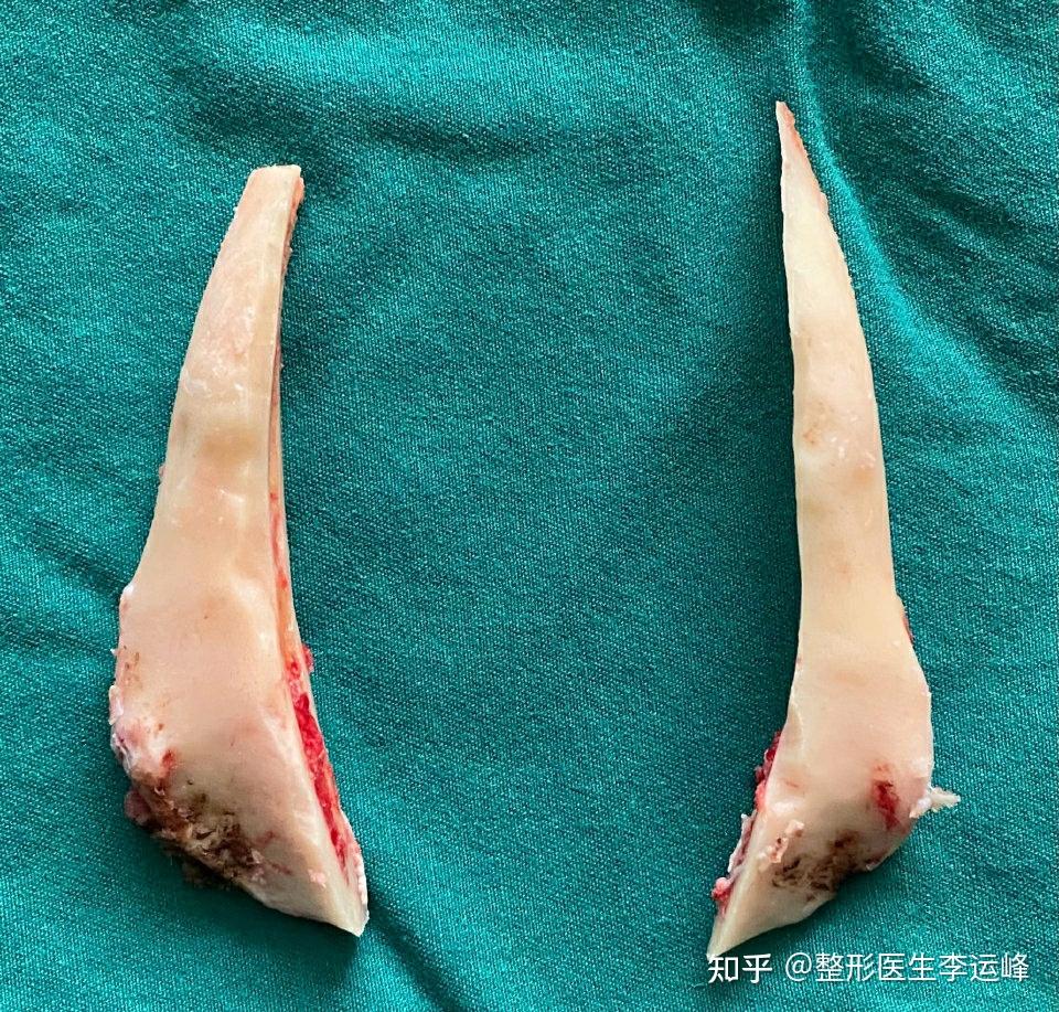 长曲线下颌角截骨术前术后对比