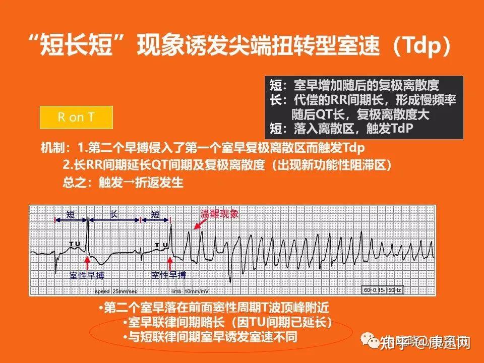 及时预测心脏猝死风险!心脏猝死预警心电图分析,建议收藏! - 知乎