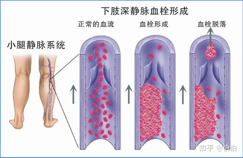 静脉血栓栓塞症(VTE)——“沉默杀手”的识别与防控 - 知乎