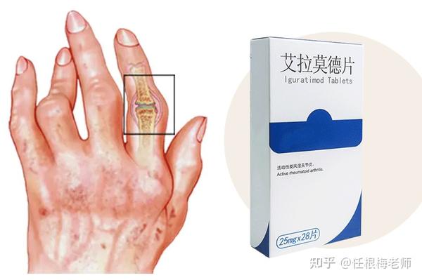 艾拉莫得治疗类风湿关节炎效果如何?单用还是联用?如何正确使用 - 知乎