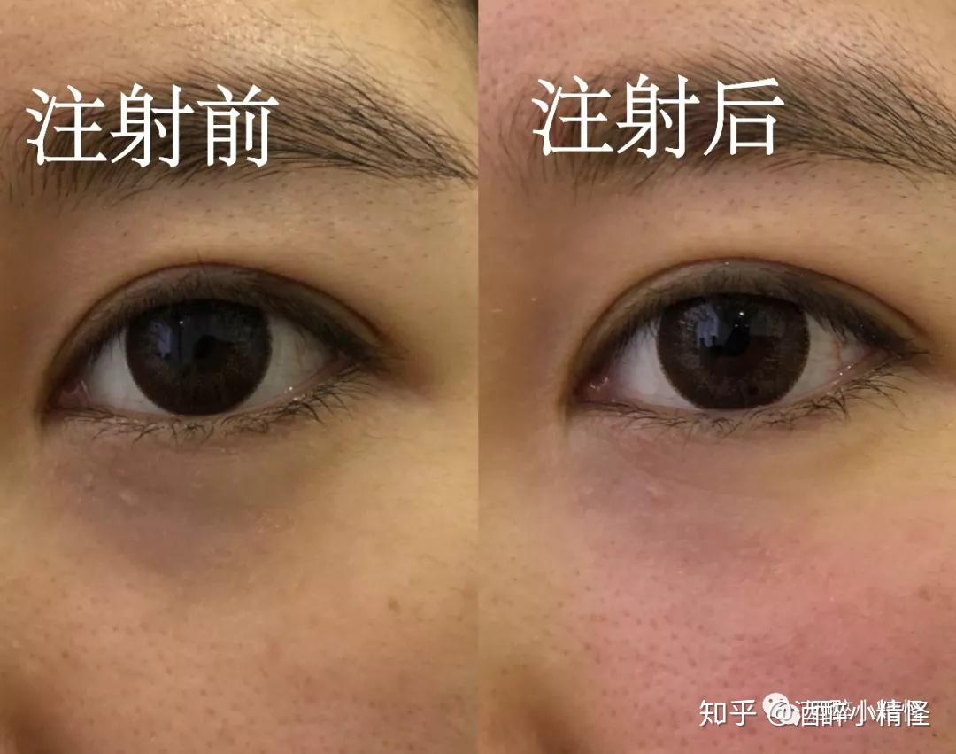 精彩回顾|李锦阳教授：泪膜破裂时间和类型引导的干眼诊断