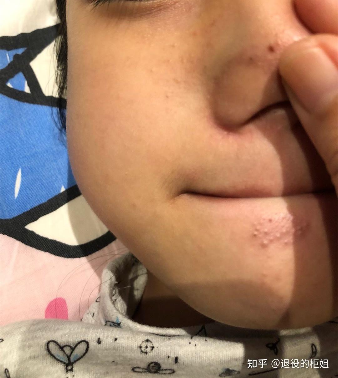 八岁女孩鼻子长黑头用什么好