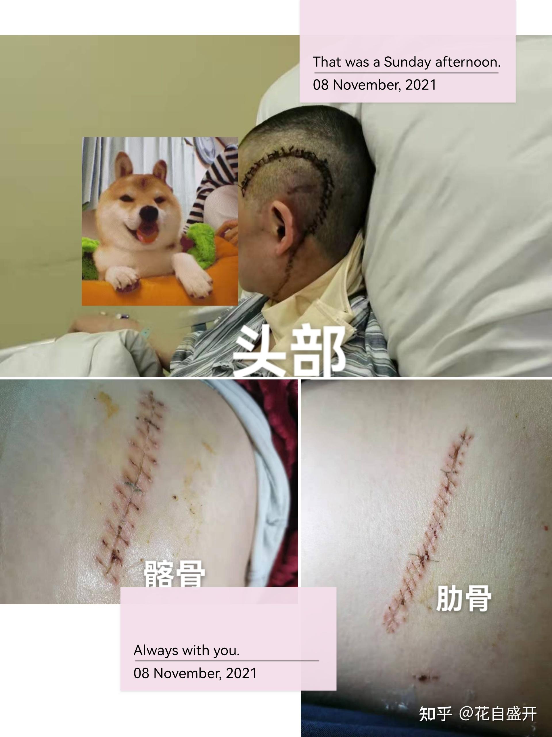 記錄顳下頜關節腫瘤軟骨肉瘤1級腱鞘鉅細胞瘤上海九院就診經歷和自己