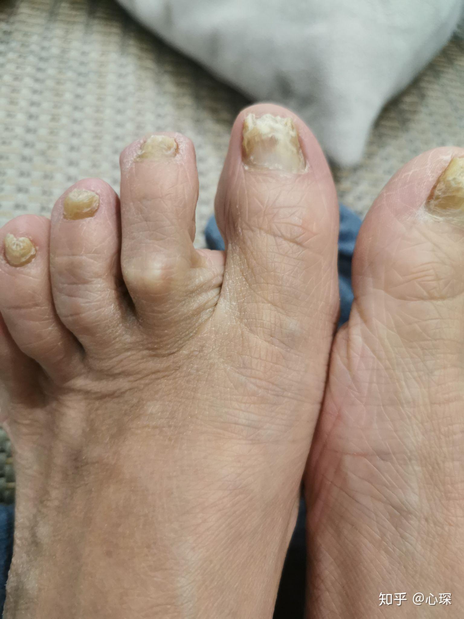 这是黄甲综合征吗