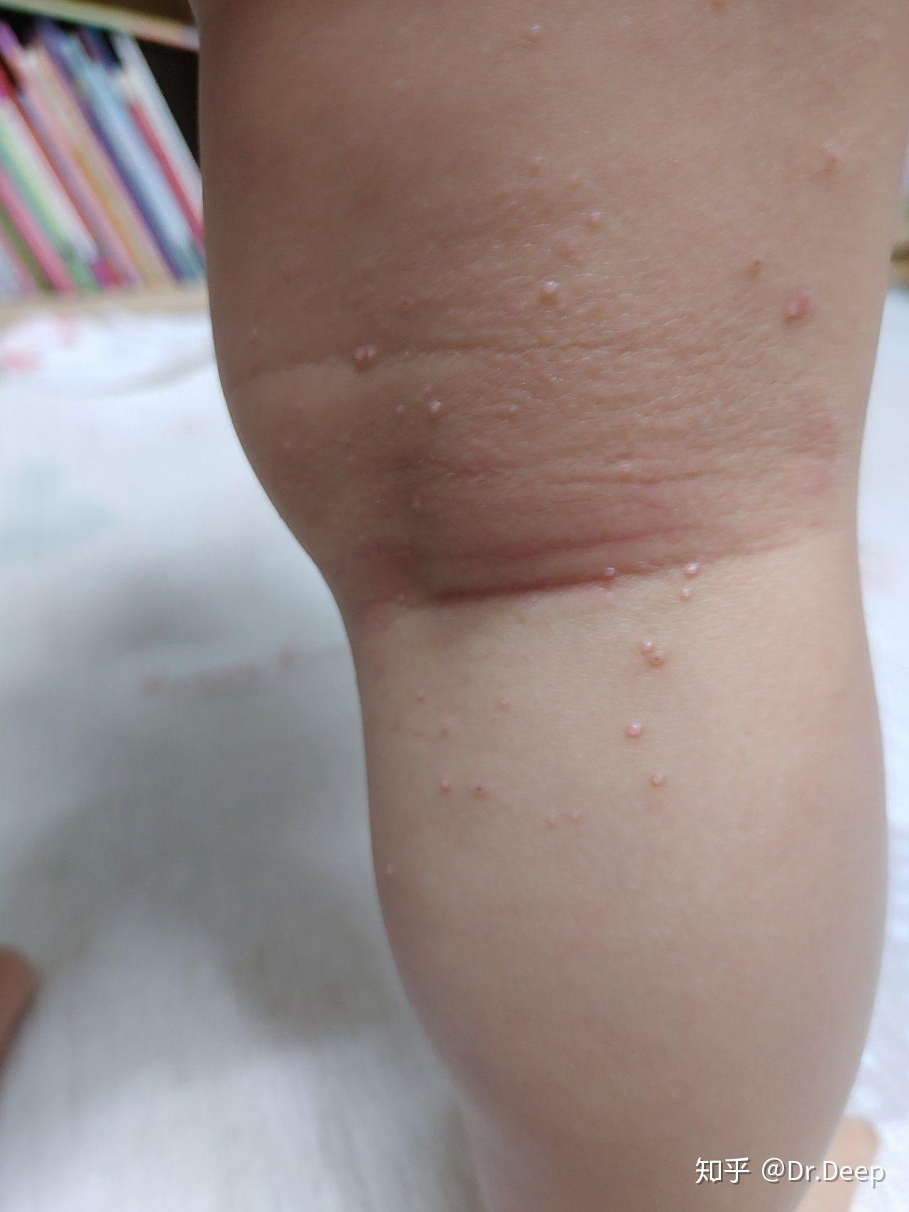 傳染性軟疣 – 范姜皮膚科診所