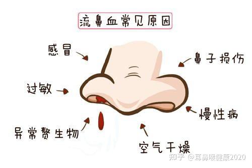鼻出血如何有效地止血 知乎