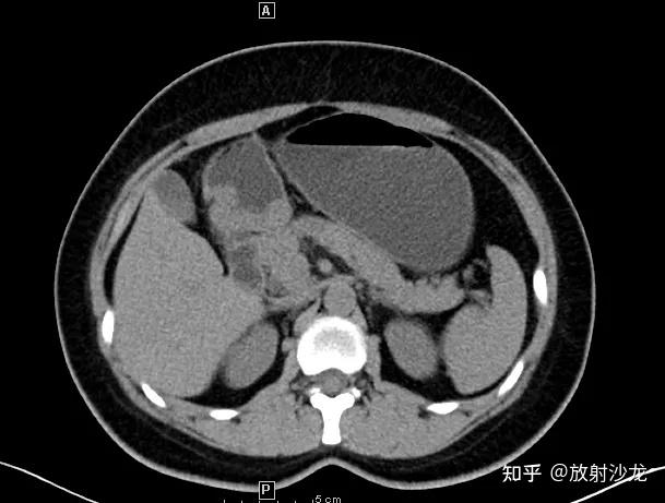这5种常见胃良性占位的鉴别诊断，你真不一定懂！ - 知乎
