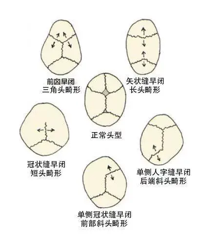 究竟是什么神秘力量,让中国孩子集体扁了头? - 知乎